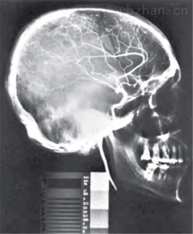 American RSD phantom angiography head phantom image 3